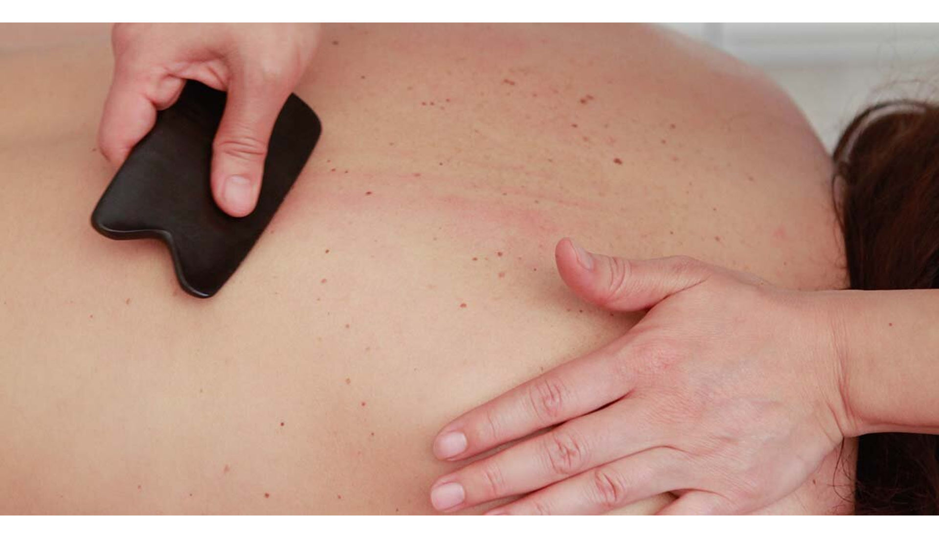 Gua Sha or Chinese Scrapping Therapy